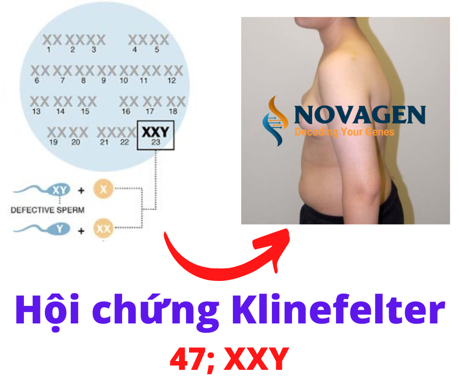 Hội chứng Klinefelter (47, XXY) ở nam giới